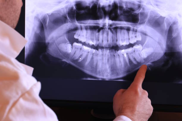 Best Emergency Wisdom Tooth Extraction in Shoreline, WA